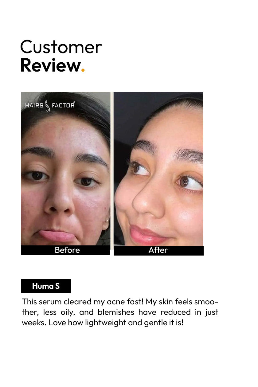 ANTI ACNE SERUM (30ml) (GURANTEED RESULTS IN 7-DAYS)