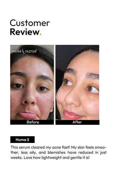 ANTI ACNE SERUM (30ml) (GURANTEED RESULTS IN 7-DAYS)